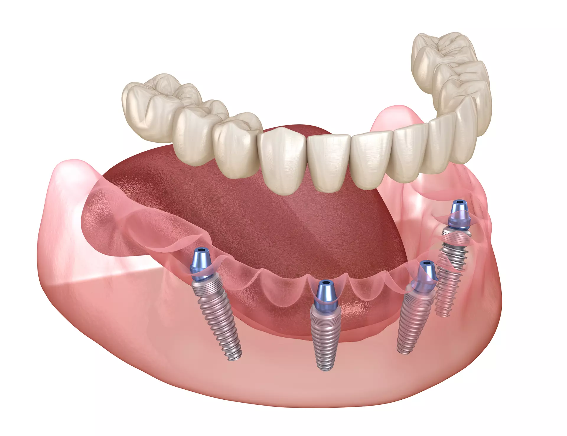All-On-4 Implants  Granada Hills, CA 